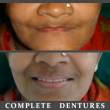 Complete Dentures