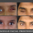 Maxillofacial Prosthetics